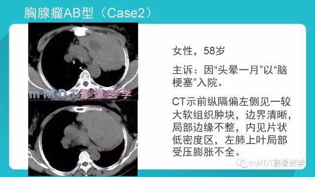 【PPT】纵隔肿瘤影像诊断（全）