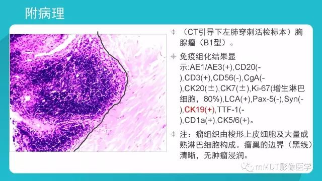 【PPT】纵隔肿瘤影像诊断（全）