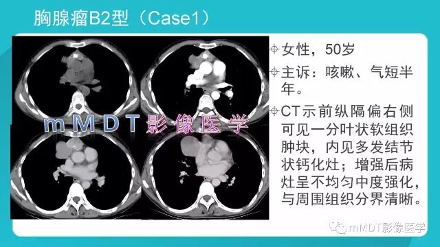 【PPT】纵隔肿瘤影像诊断（全）