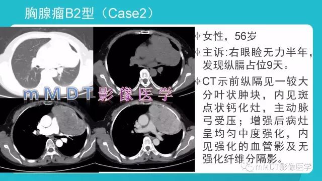 【PPT】纵隔肿瘤影像诊断（全）