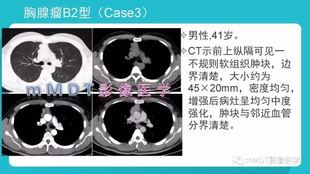 【PPT】纵隔肿瘤影像诊断（全）