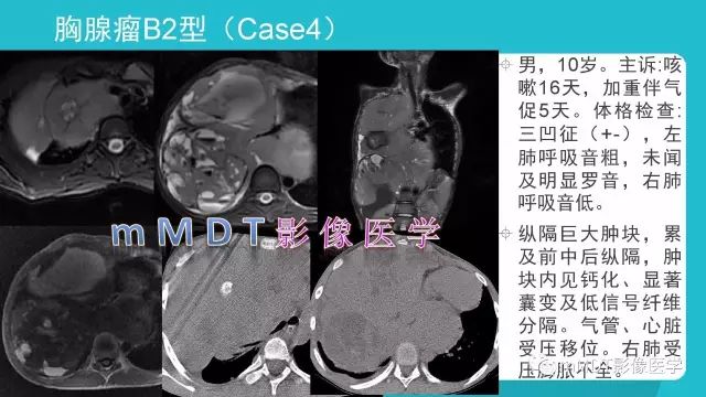 【PPT】纵隔肿瘤影像诊断（全）