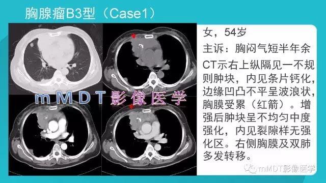 【PPT】纵隔肿瘤影像诊断（全）