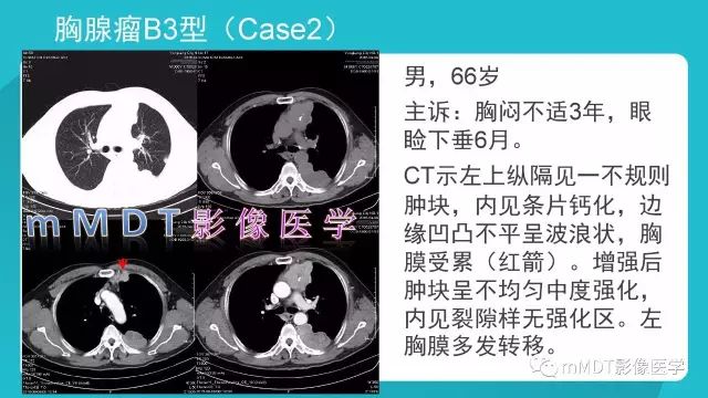 【PPT】纵隔肿瘤影像诊断（全）
