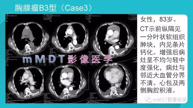 【PPT】纵隔肿瘤影像诊断（全）