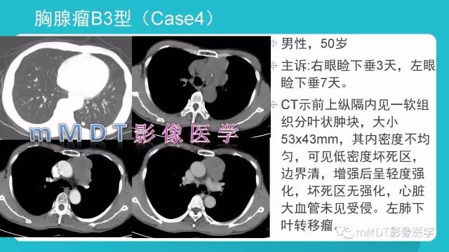 【PPT】纵隔肿瘤影像诊断（全）