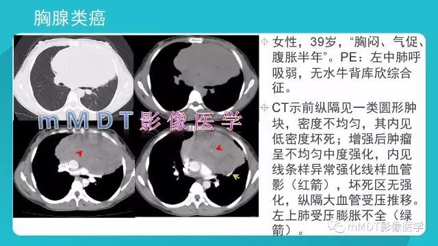 【PPT】纵隔肿瘤影像诊断（全）