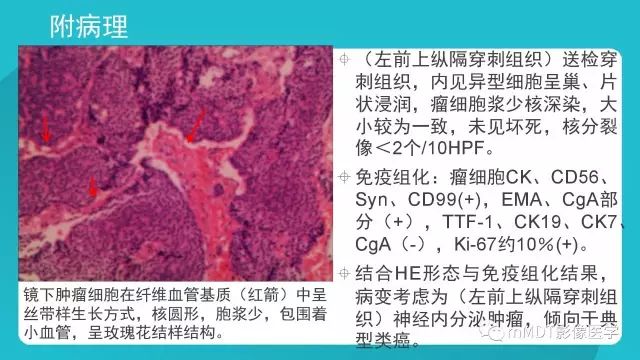【PPT】纵隔肿瘤影像诊断（全）