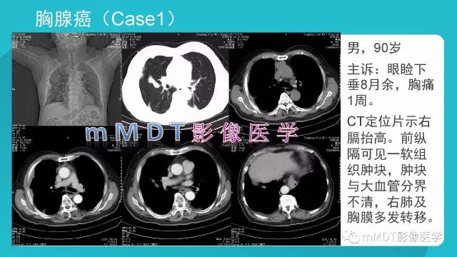 【PPT】纵隔肿瘤影像诊断（全）