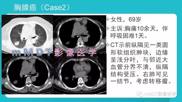 【PPT】纵隔肿瘤影像诊断（全）