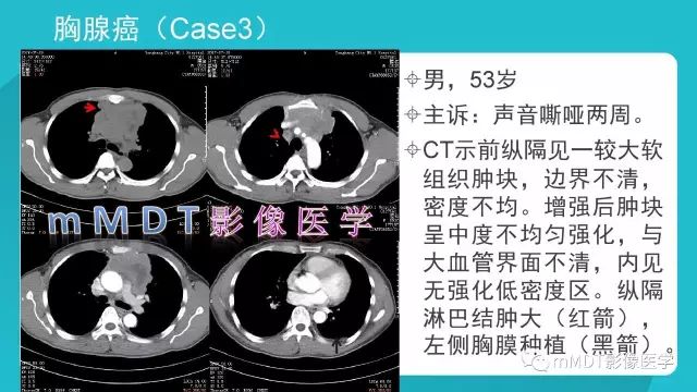 【PPT】纵隔肿瘤影像诊断（全）