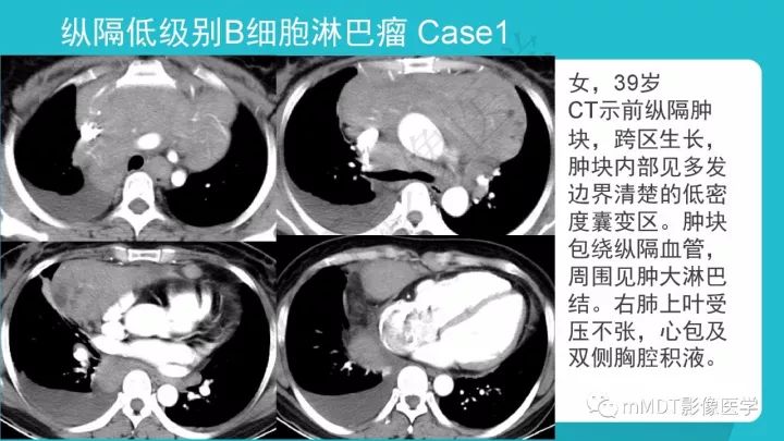 【PPT】纵隔肿瘤影像诊断（全）