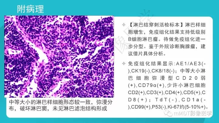 【PPT】纵隔肿瘤影像诊断（全）