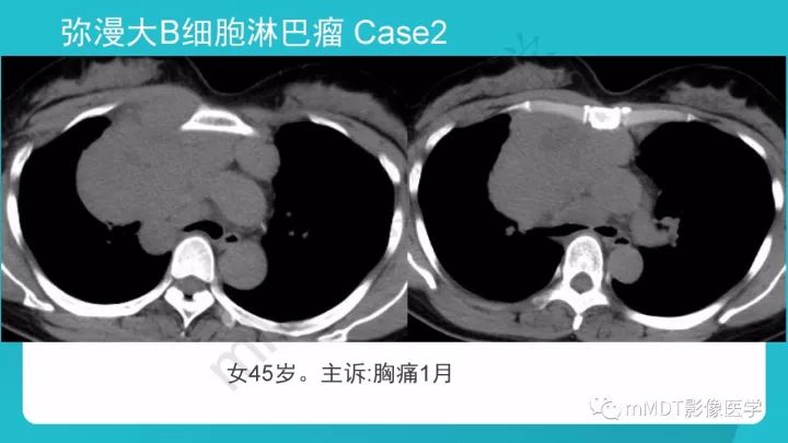 【PPT】纵隔肿瘤影像诊断（全）