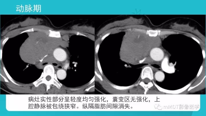 【PPT】纵隔肿瘤影像诊断（全）