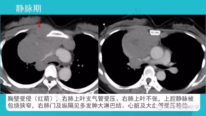 【PPT】纵隔肿瘤影像诊断（全）