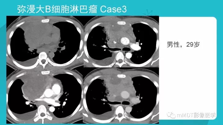 【PPT】纵隔肿瘤影像诊断（全）