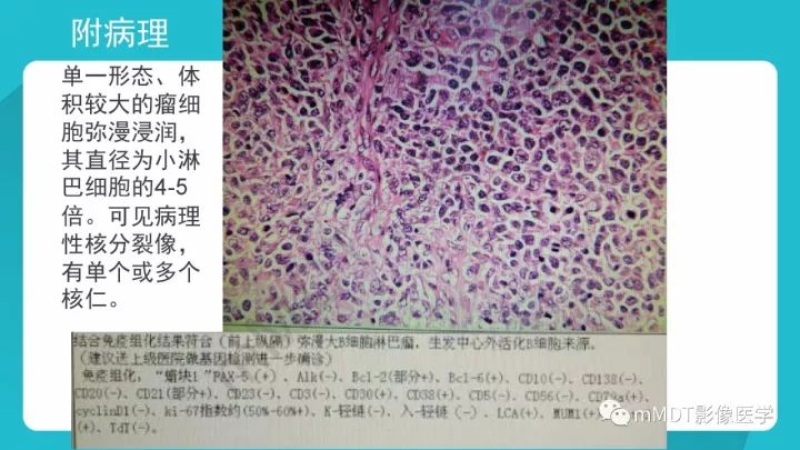 【PPT】纵隔肿瘤影像诊断（全）