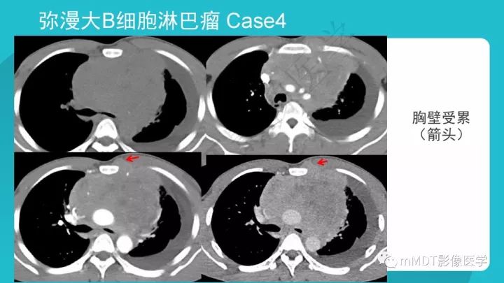 【PPT】纵隔肿瘤影像诊断（全）