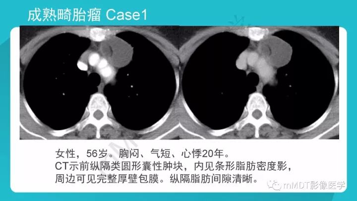 【PPT】纵隔肿瘤影像诊断（全）