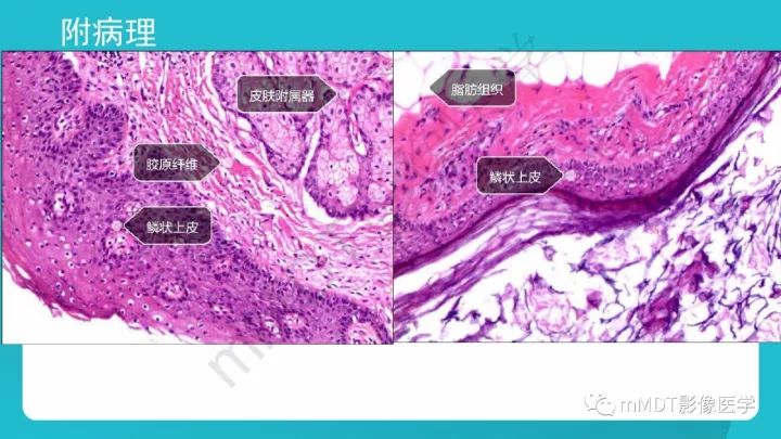 【PPT】纵隔肿瘤影像诊断（全）