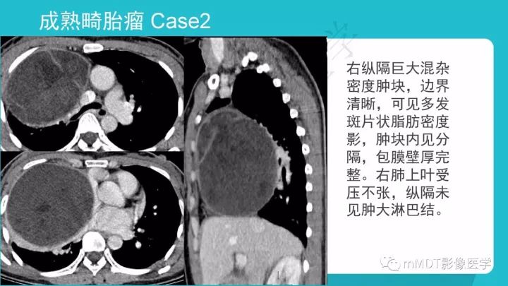 【PPT】纵隔肿瘤影像诊断（全）
