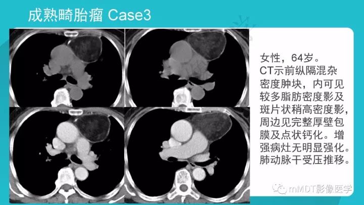 【PPT】纵隔肿瘤影像诊断（全）