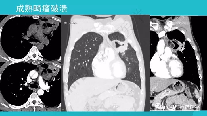 【PPT】纵隔肿瘤影像诊断（全）