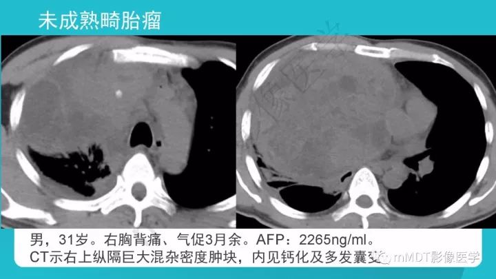 【PPT】纵隔肿瘤影像诊断（全）