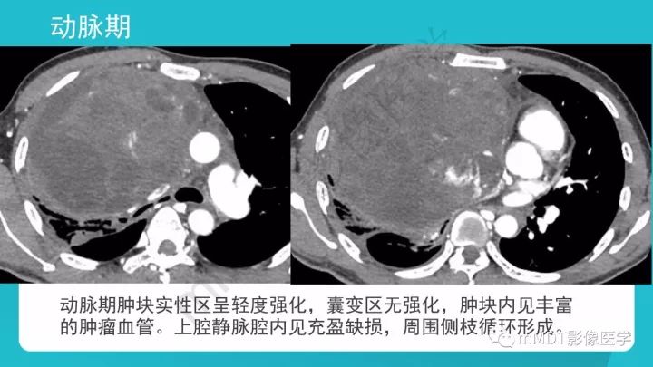 【PPT】纵隔肿瘤影像诊断（全）