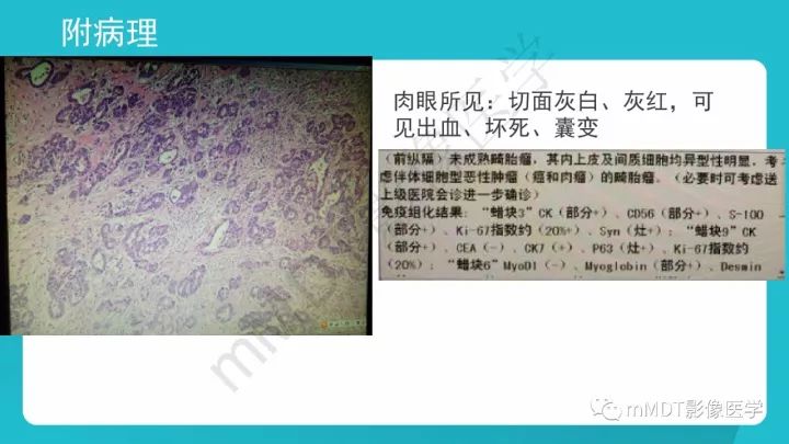 【PPT】纵隔肿瘤影像诊断（全）