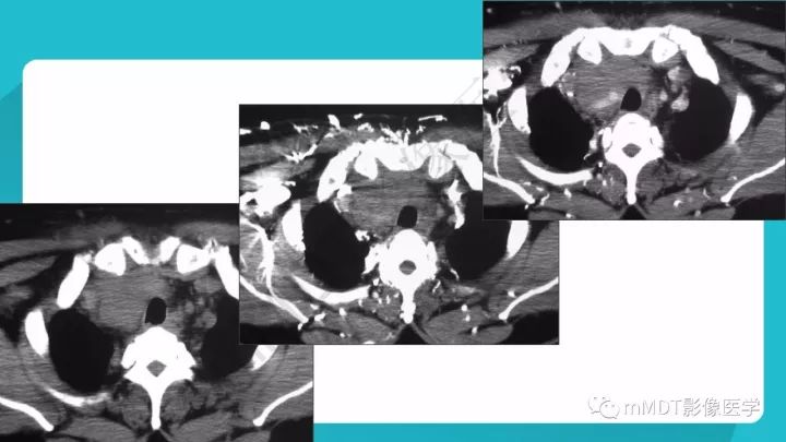 【PPT】纵隔肿瘤影像诊断（全）