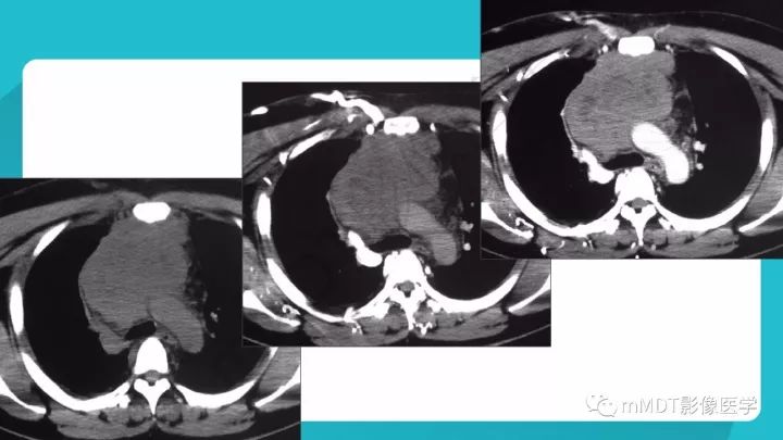 【PPT】纵隔肿瘤影像诊断（全）