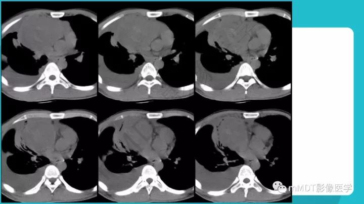 【PPT】纵隔肿瘤影像诊断（全）