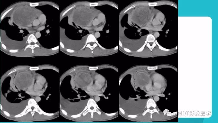 【PPT】纵隔肿瘤影像诊断（全）