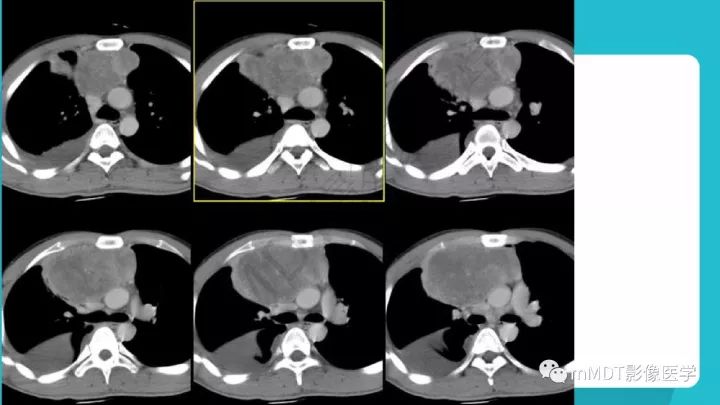 【PPT】纵隔肿瘤影像诊断（全）