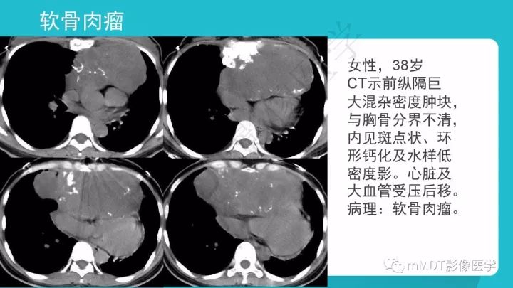 【PPT】纵隔肿瘤影像诊断（全）