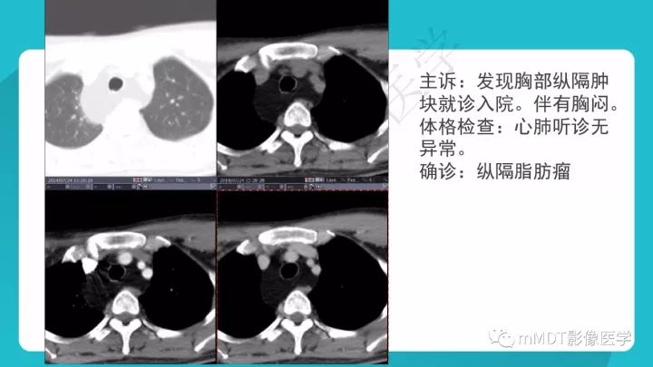 【PPT】纵隔肿瘤影像诊断（全）