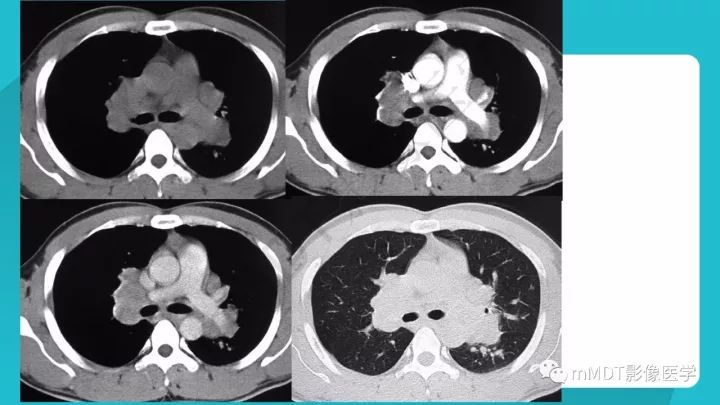 【PPT】纵隔肿瘤影像诊断（全）