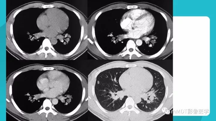 【PPT】纵隔肿瘤影像诊断（全）
