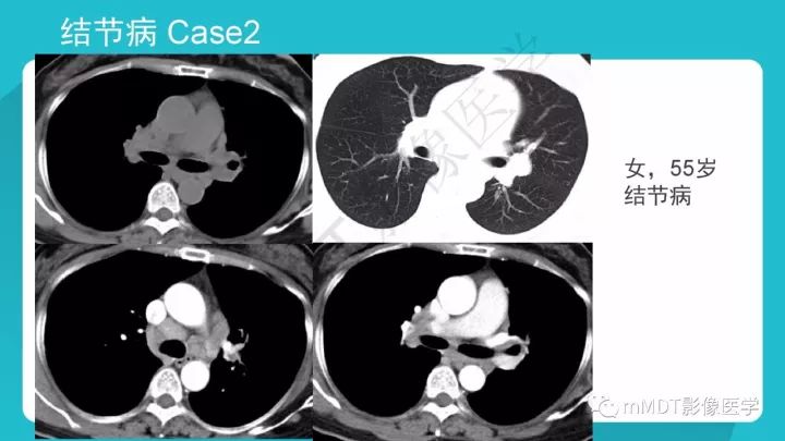 【PPT】纵隔肿瘤影像诊断（全）