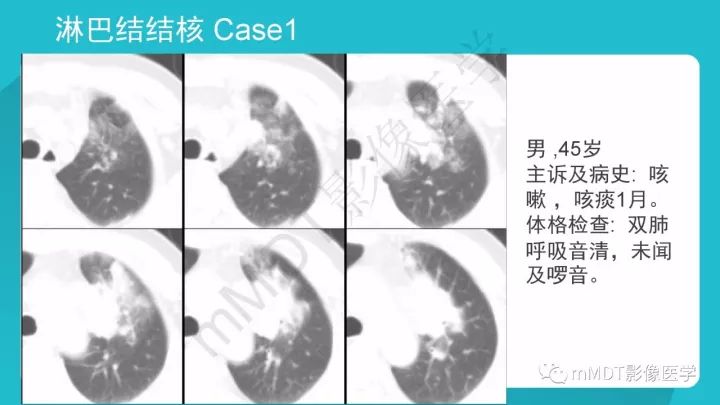 【PPT】纵隔肿瘤影像诊断（全）