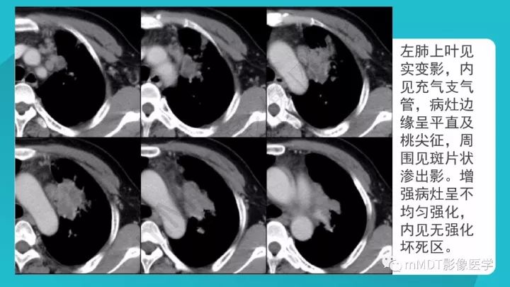 【PPT】纵隔肿瘤影像诊断（全）