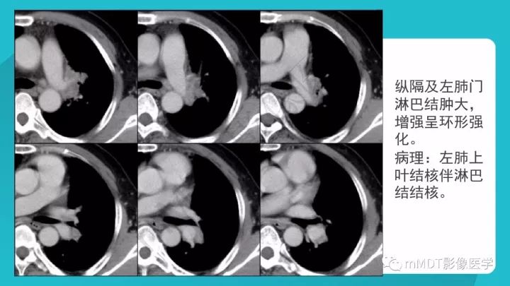 【PPT】纵隔肿瘤影像诊断（全）