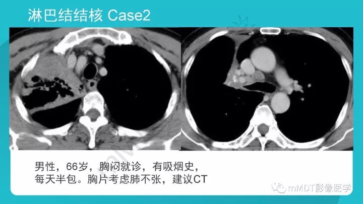 【PPT】纵隔肿瘤影像诊断（全）
