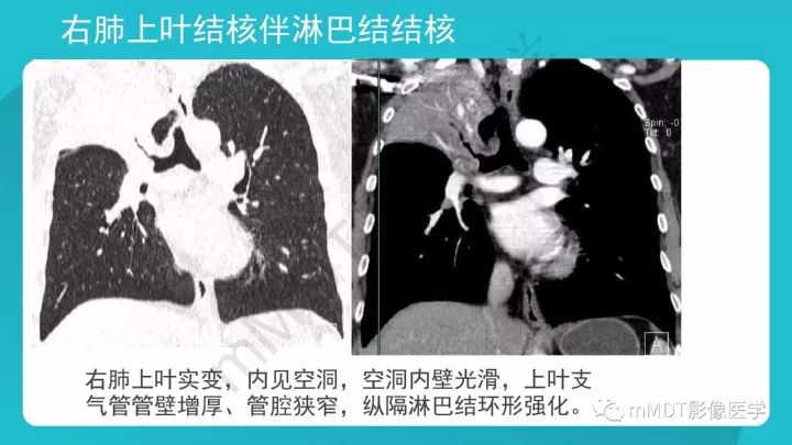 【PPT】纵隔肿瘤影像诊断（全）