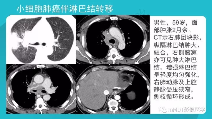 【PPT】纵隔肿瘤影像诊断（全）