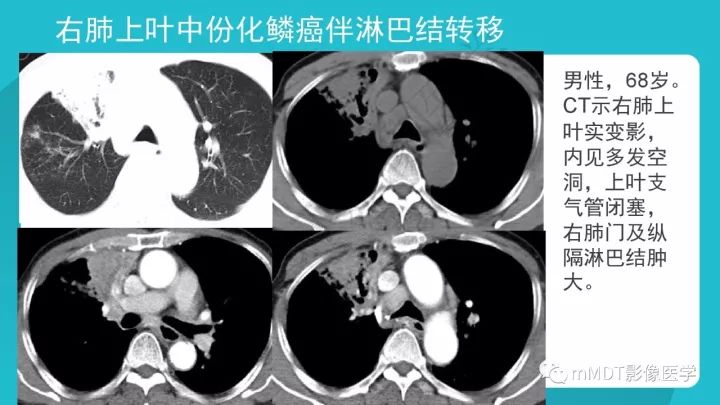 【PPT】纵隔肿瘤影像诊断（全）