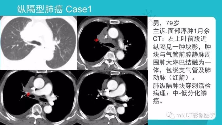 【PPT】纵隔肿瘤影像诊断（全）
