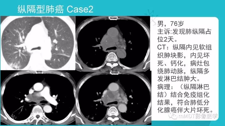 【PPT】纵隔肿瘤影像诊断（全）